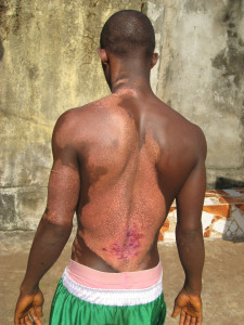 The skin on John Kanu's back was almost entirely healed 28 days after starting treatment.