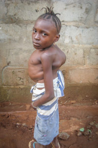 Fati Mansaray, age 10, before surgical treatment to her spine. 