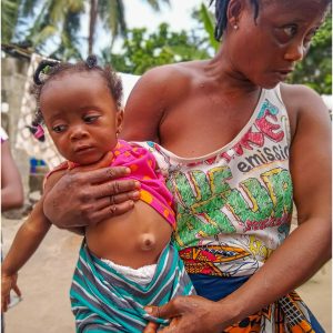 Little Mariatu Fullah, who is suffering from painful umbilical hernia, is also included in the first group of our resumed hernia program.